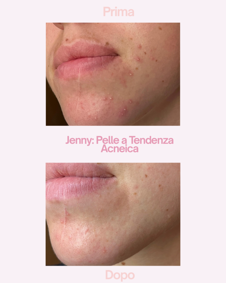 Caso studio: Imperfezioni